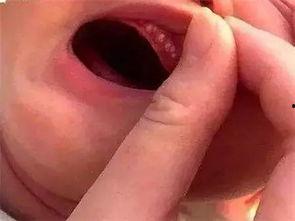 小孩吃瓜过敏嘴巴红肿,警惕夏日常见食物过敏反应